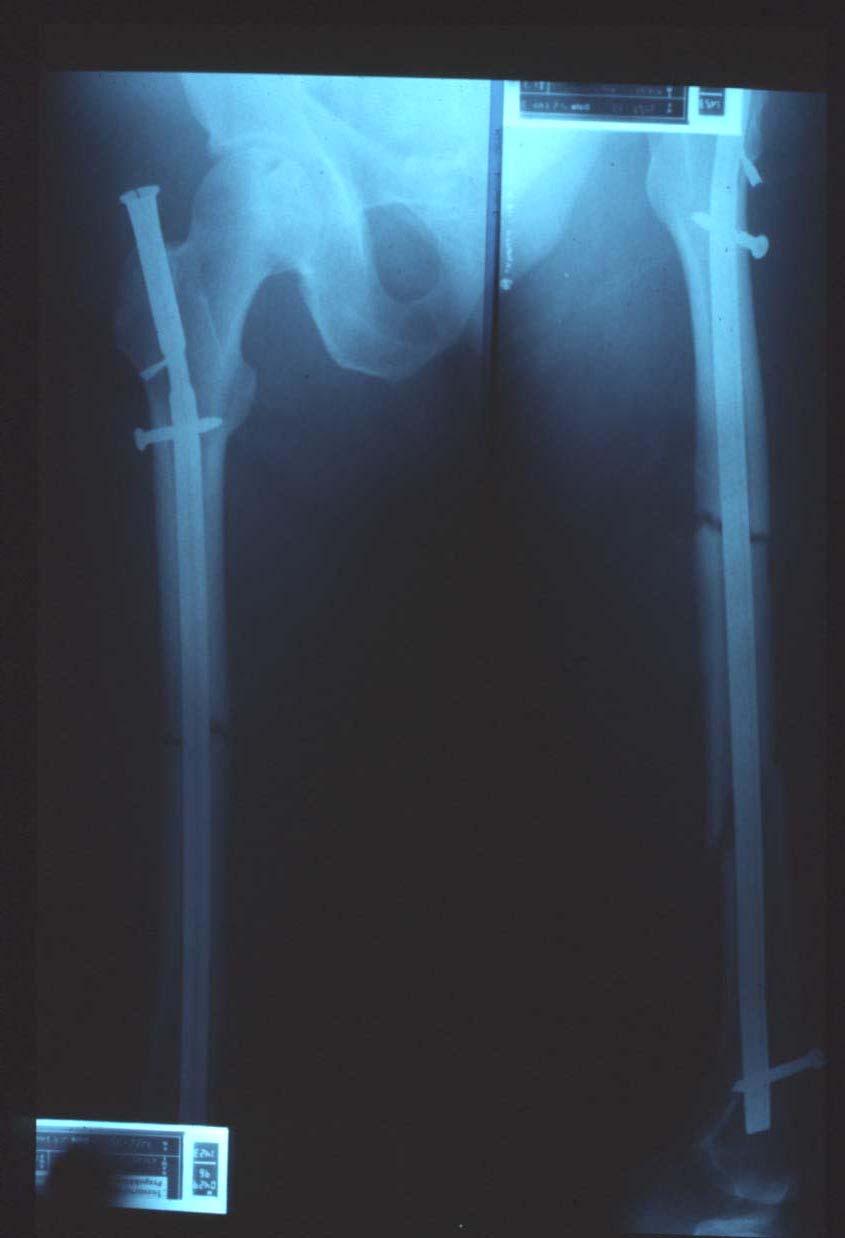 Fracture of the shaft of the femur Intramedullary nailing Closed nailing