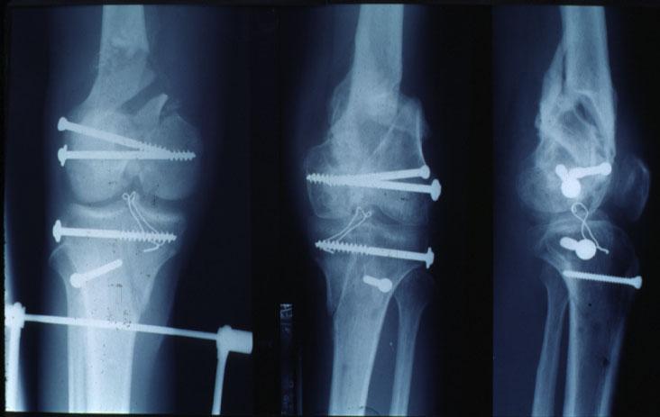 Fractures around the knee Fracture of the distal femur Fractures of the tibial