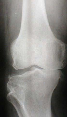 Fracture of the distal femur General