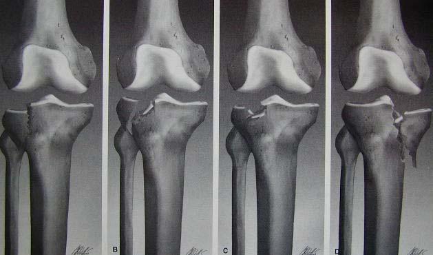 around the knee Swelling around the knee