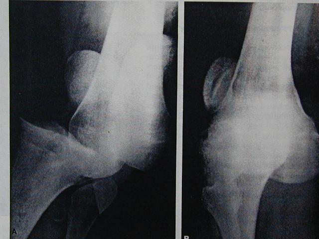 Knee dislocation and fracture dislocation Knee dislocation