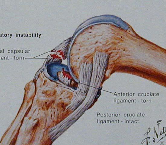Knee dislocation Anterior Hyperextension