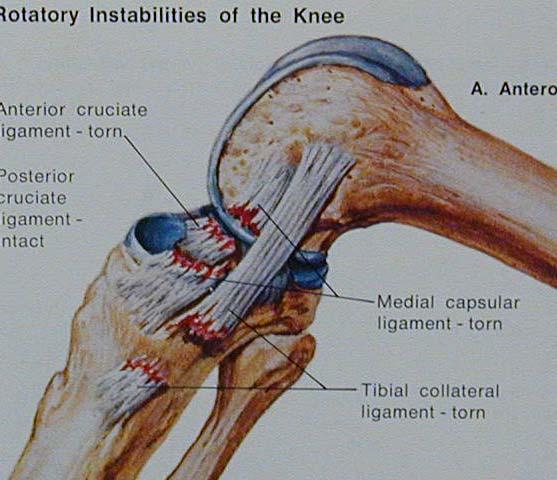 ligaments Rotatory Posterolateral