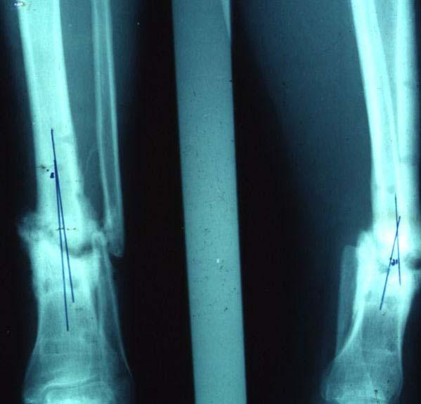 Complications of fractures