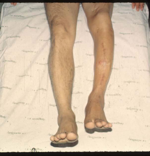 Compartment syndrome Fat