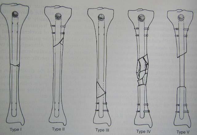Fractures of the tibia Mechanism