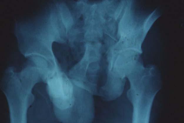 Fat embolism Common in Fx of long bone and pelvis Multiple