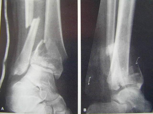 Fracture of the tibial plafond Definition Fx of the distal