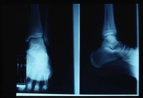 Ankle fractures investigation X-ray
