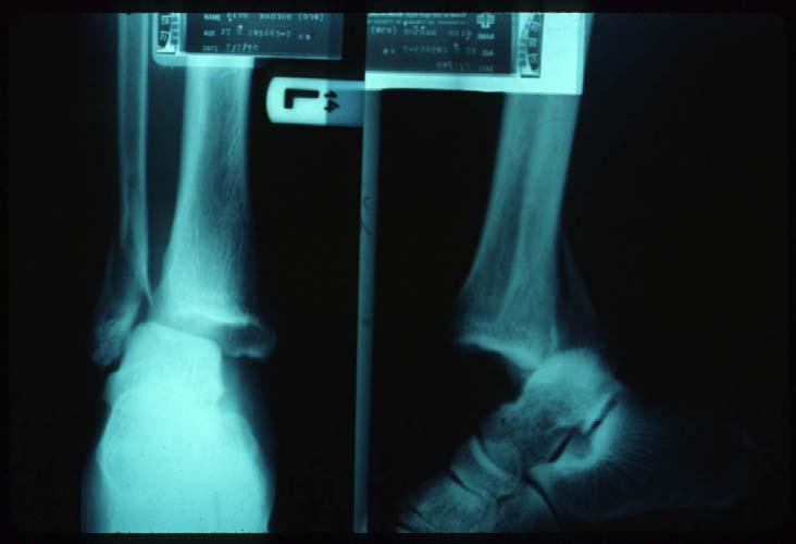 Ankle dislocation and fracture dislocation General
