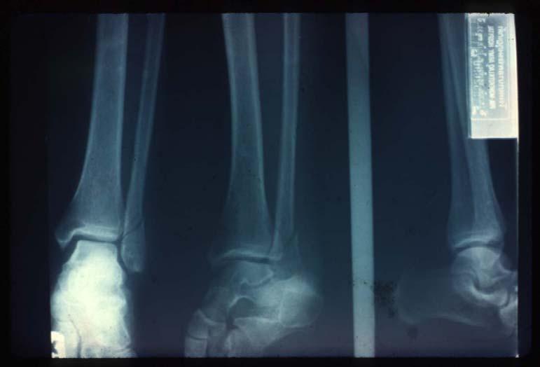 around the ankle and dislocation Associated fractures