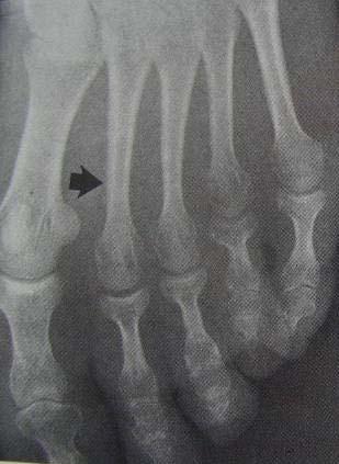 Stress fractures Excessive,