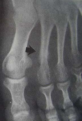 Most common: 2 nd metatarsal,