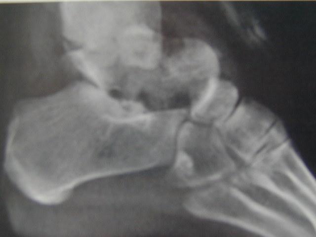Fracture of the talus Neck, head, body and process