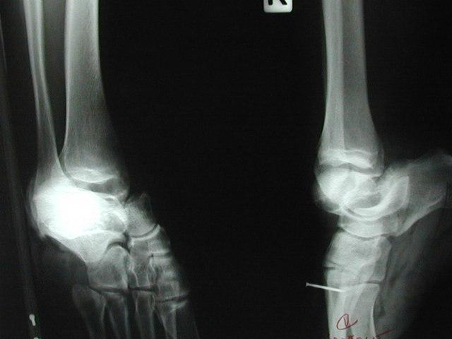 May associated dislocation Subtalar joint Ankle