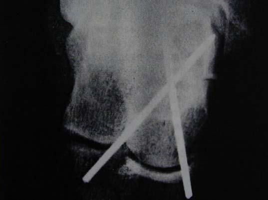 Fractures of the tarsals and joint injuries Diagnosis Usually