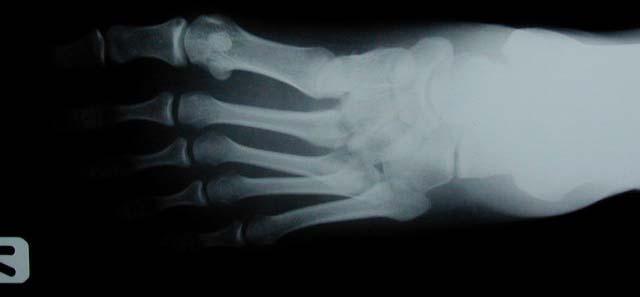 nonoperative SLC 4-6 wk Midtarsal joint CR and/or pin and SLC