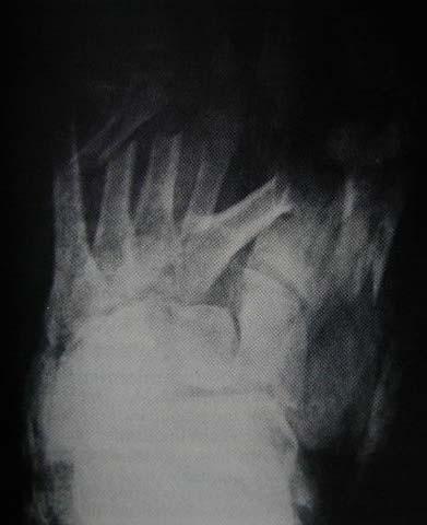 Fractures of the metatarsals and phalanges General Usually nonoperative treatment SLC 4-6 wk Some conditions Open Fx with
