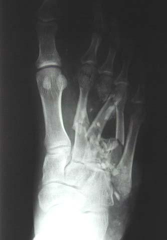Fractures of the metatarsals and