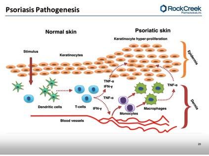 Chronic immune modulated inflammatory skin disease Hyper-proliferation of