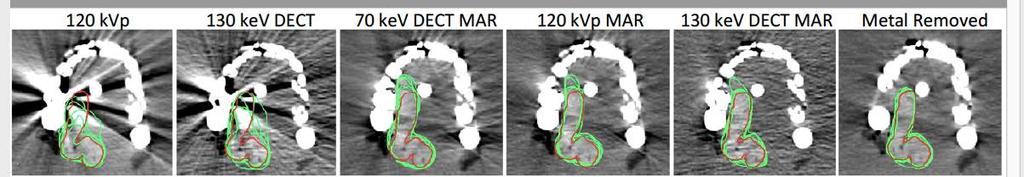 Improved precision AND accuracy Combination of MAR and DE CT most