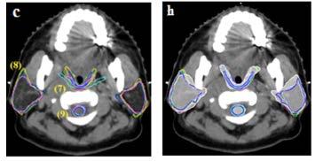 Automatic delineation Atlas from consensus guidelines 20 OARs, nasopharyngeal carcinoma