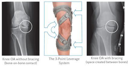 Bracing: Knee OA Unloader knee brace Routine bracing for knee OA not recommended Unloader