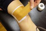 Possible mechanisms behind patellar taping efficacy include earlier VMO onset and improved knee function capacity (ie, ability to