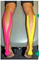 tape has been used to limit all movements to give the Achilles tendon support. Firsth BL, et al.