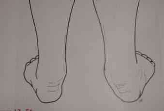 TIBIALIS POSTERIOR DYSFUNCTION Excessive hindfoot valgus Patient cannot stand tip toe Too many toe signs FLATFOOT Look for whether arch is formed by Dorsiflexion of the great toe or standing tiptoe