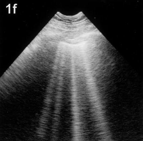 Lung rockets or B lines are produced by reverberation in a cluster of four bubbles.