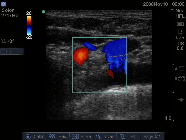 Usual angle of insonation is 60 degrees Doppler is used to measure and display blood flow.