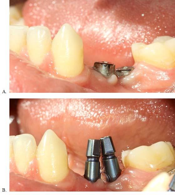 FIGURE 2. A) Intra-oral view of implant fixtures. B) Impression coping to show degree of proximity of implant fixtures.