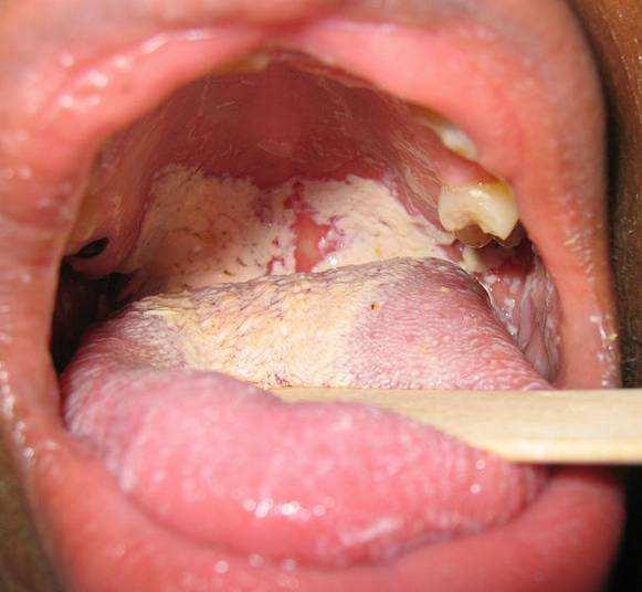 ICS - general ADEs overall, ADEs risk significantly reduced with ICS local infections in mouth and pharynx importance of.
