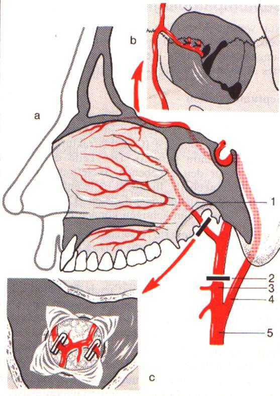 nasopharyngeal area can be treated by means of