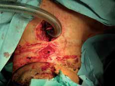 airway management is performed by means of either tracheal intubation with a cuffed tube to prevent aspiration or an