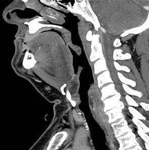 CT 43 MRI 44 Verterbral column