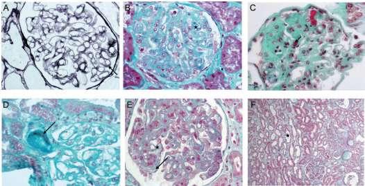 Anti-VEGF agents and pre-eclampsia-like syndrome 22 patients Renal biopsy 16.2 ± 10.