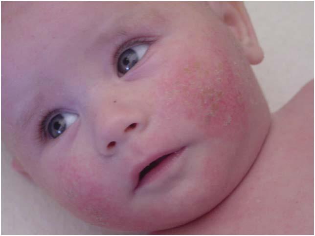 Eczema Basics 9 Fig. 1.5 Eczema on infant s cheeks. The rash usually does not appear in the diaper area. The rash presents most commonly as dry, red, scaling areas on the baby s cheeks.