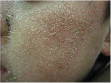 10 LIVING WITH ECZEMA Fig. 1.6 An older child with dry rash. Adolescents and adults AD often improves as children get older.