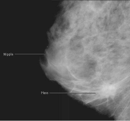 Our Patient: 61 yo female, yearly mammogram Suspicious right breast mass: spiculated,, poorly defined margins, destruction of normal tissue