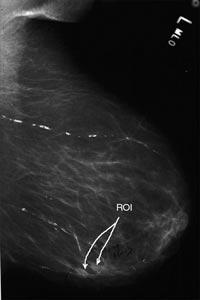 Optical Imaging: Laser Mammography