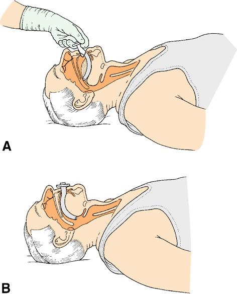 OROPHARYNGEAL AIRWAYS Sized by placing airway next to the patient s face with the flange at the level of the teeth, the tip should reach the angle of the jaw Insert the guedels airway with the curve