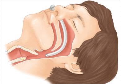 NASOPHARYNGEAL AIRWAYS Select a NP airway that has a diameter slightly smaller than the diameter of the patient s nares.