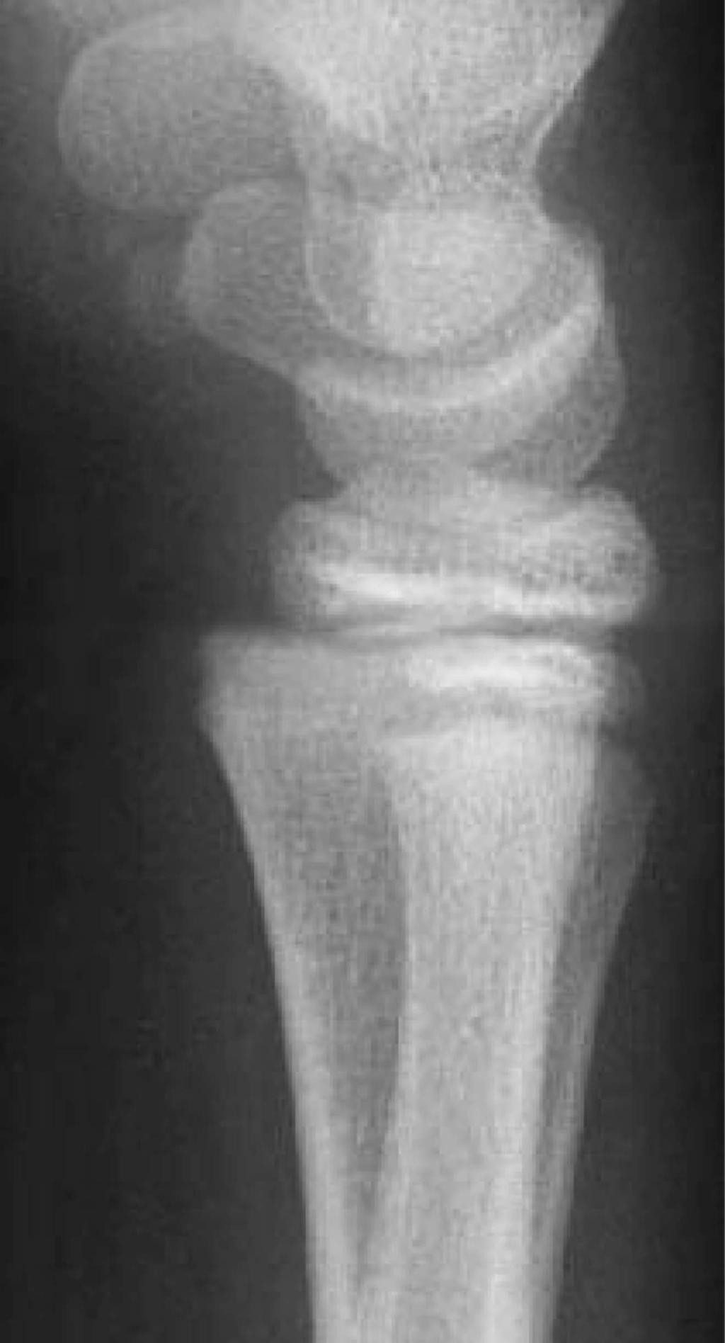 14 Advanced Emergency Nursing Journal aftercare instructions. He was placed in a thumb cast for 4 weeks. After 1 month, the patient was able to resume normal activities without restriction. Figure 4.