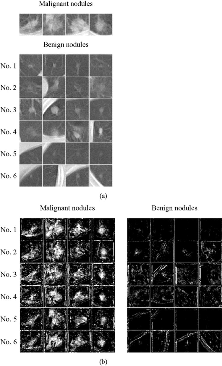 Note that the output images of each MTANN for malignant nodules correspond to the same four input images. output images of each trained MTANN for training cases are shown in Fig. 5.