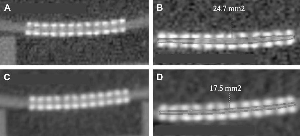 Min et al HDCT to evaluate coronary artery stents 249 Figure 2 (Upper panels) HDCT image of stent, with detailed kernel, for diameter (A) and intraluminal area (B) measurements.
