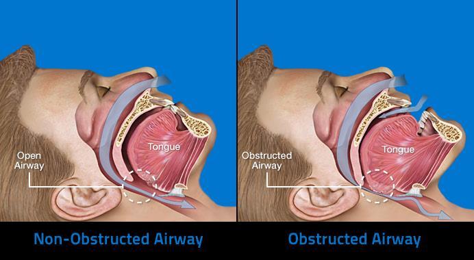 Obstructive Sleep Apnea Obstructive sleep apnea (OSA) is a disorder in which a person frequently stops breathing during his or her sleep.