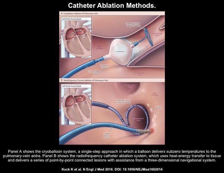 Energy sources of Catheter Ablation of Atrial