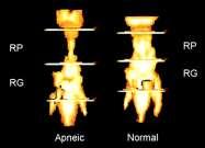 OSA Airway Decreased pharyngeal area 2 nd excess adipose tissue Uvula, tonsillar pillars, tongue, lateral pharyngeal walls MRI